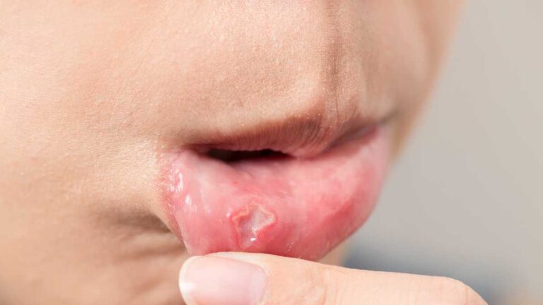 Bolinhas na boca: O que é? e tratamento