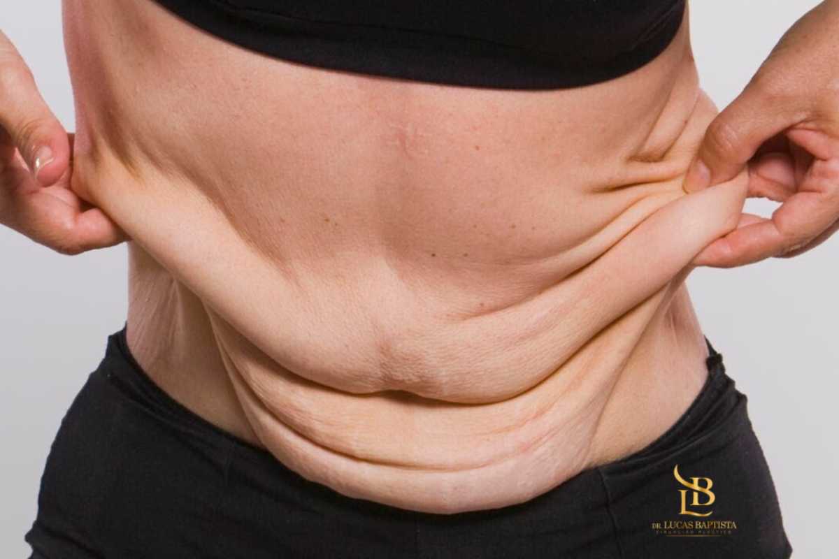 Cirurgia plástica pós-bariátrica é um direito: especialista explica quando e por que o procedimento é indicado Cirurgia plástica pós-bariátrica é um direito: especialista explica quando e por que o procedimento é indicado